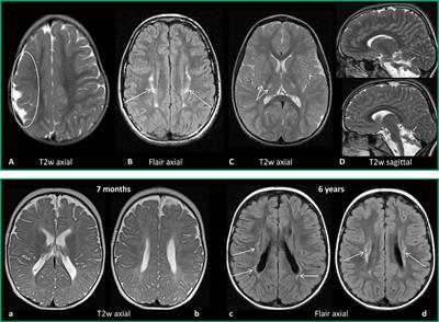 The Role of Neuroimaging and Genetic Analysis in the Diagnosis of Children With Cerebral Palsy